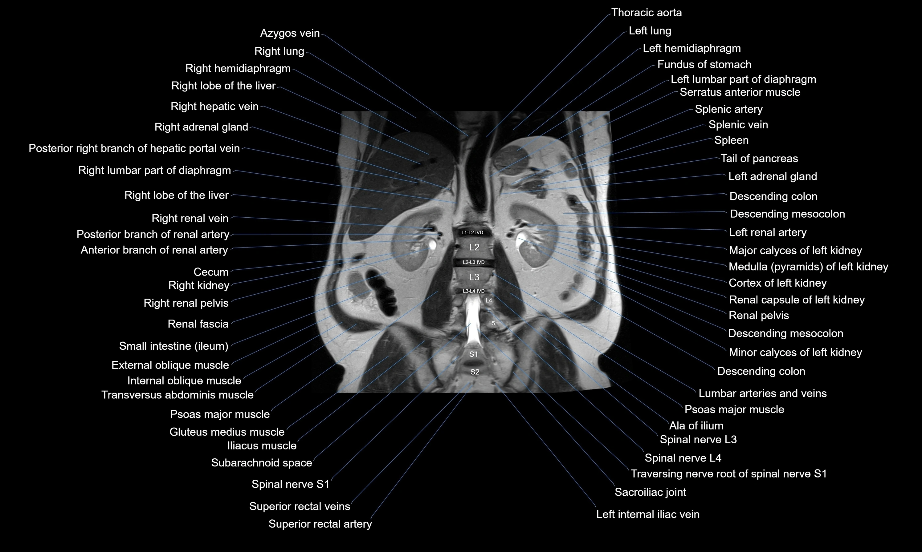 MRI Abdomen axial cross sectional anatomy radiology  image-img-00001-00038.webp